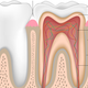 Illustration for article titled From root canal to sealed tooth